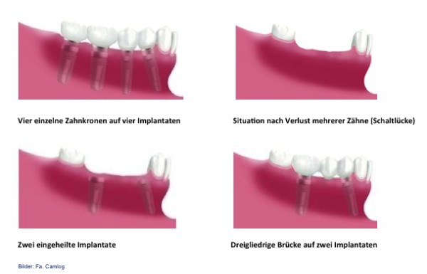 grosse Zahnlücke - Implantat